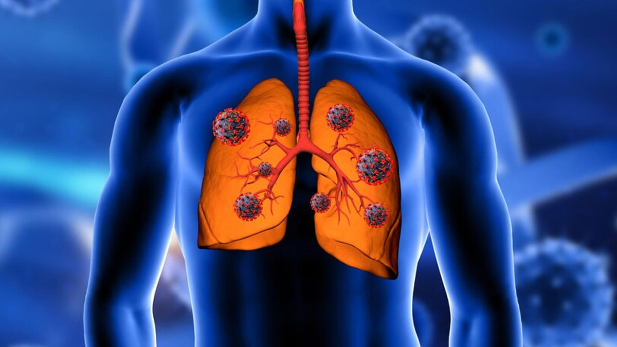 Lung Cancer: நுரையீரல் புற்றுநோயை அடையாளம் காண்பது எப்படி? என்னென்ன அறிகுறிகள் வரும்?