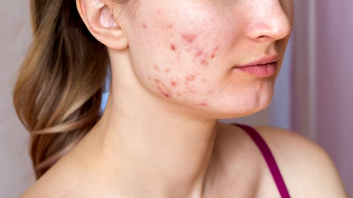 Causes of Pimples: முகத்தில் பருக்கள் வர முக்கிய காரணம்!