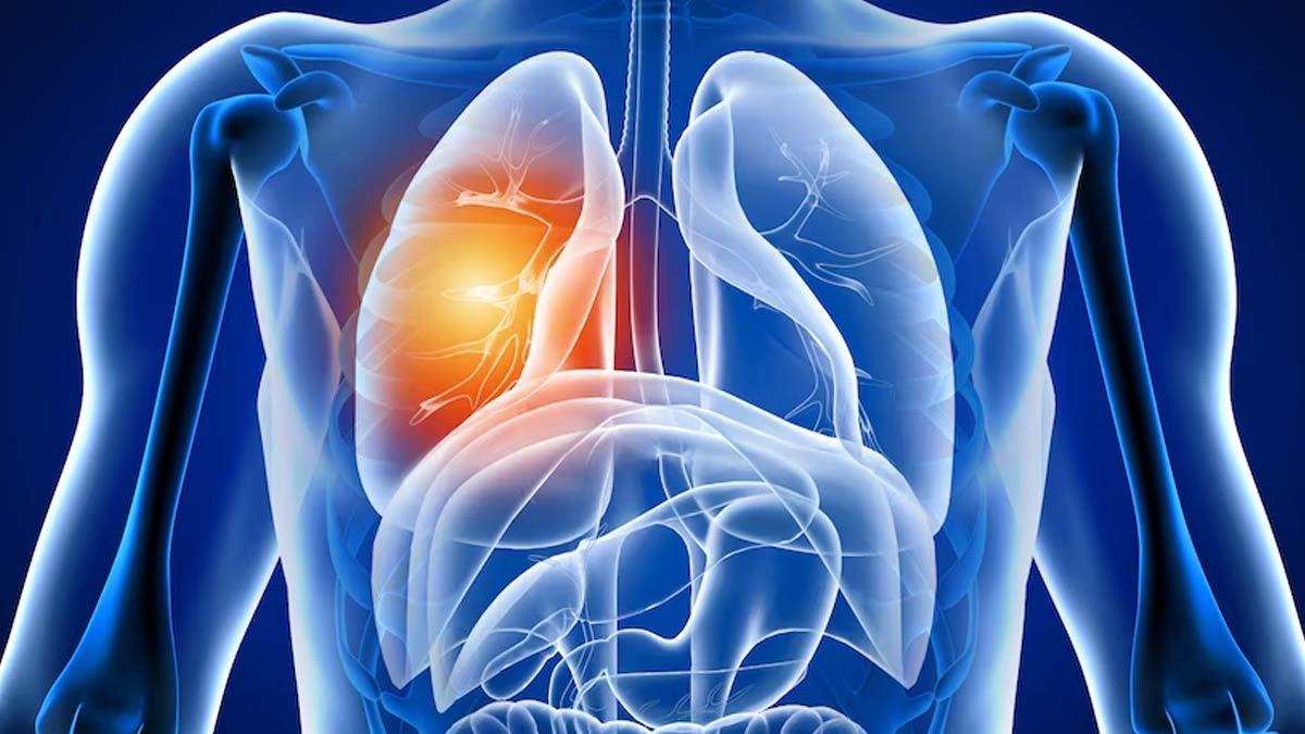 Recognise THESE Lesser Known Signs Of Lung Cancer, May Help In Early Diagnosis 