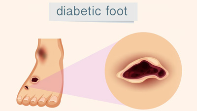 It Is Important To Take Care Of Your Feet If You Are Diabetic, Here’s The Reason 